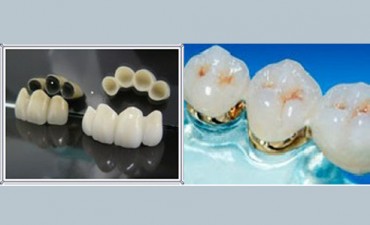 Zircon Ceramic or gold ceramic crown