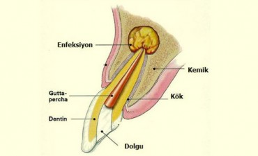 Apical Resection