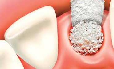Bone Graft