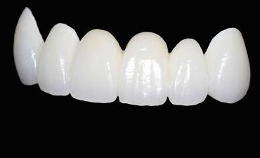 Ceramic and Zirconia Crowns