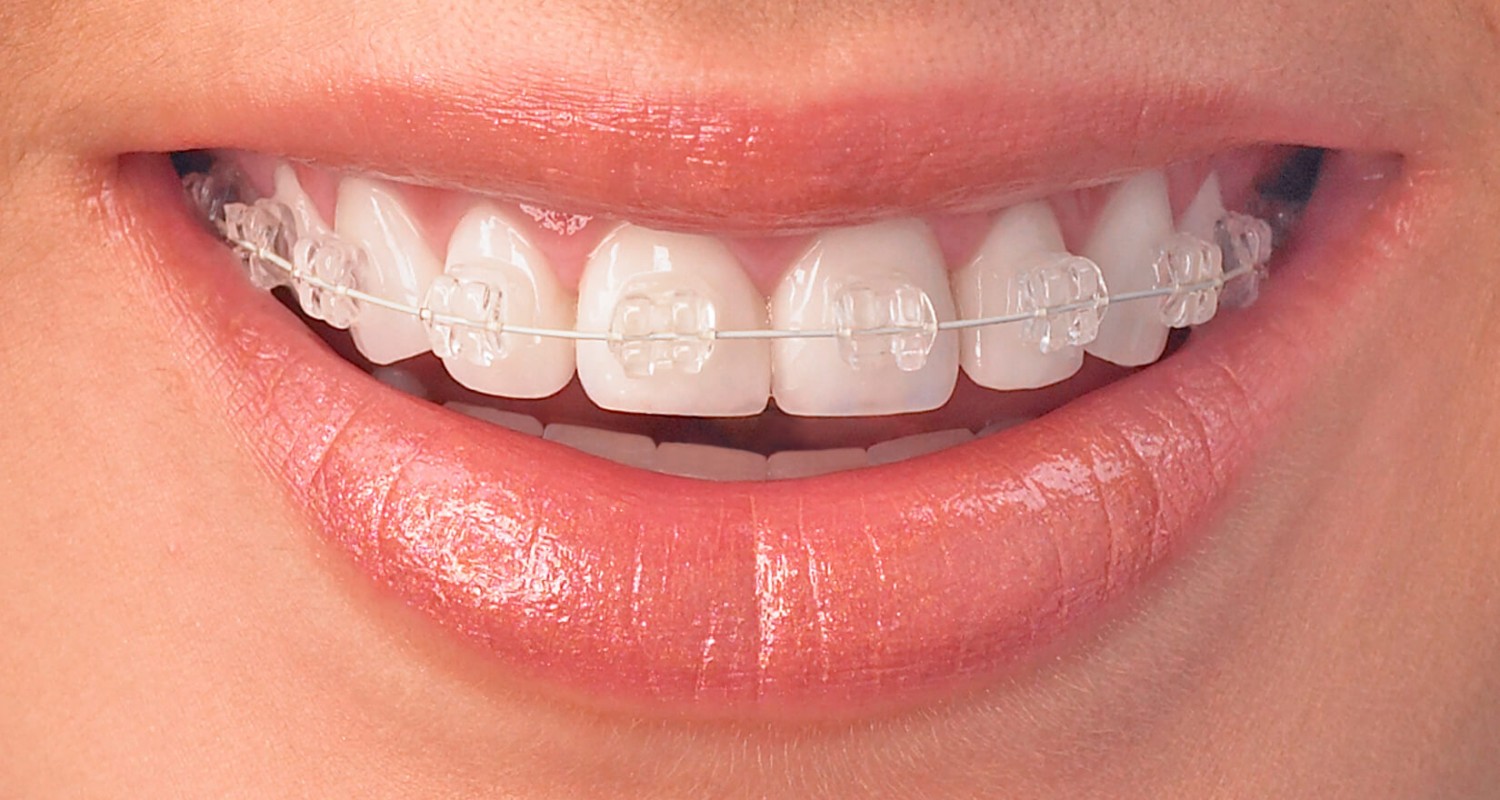 Orthodontic Braces and Treatments 