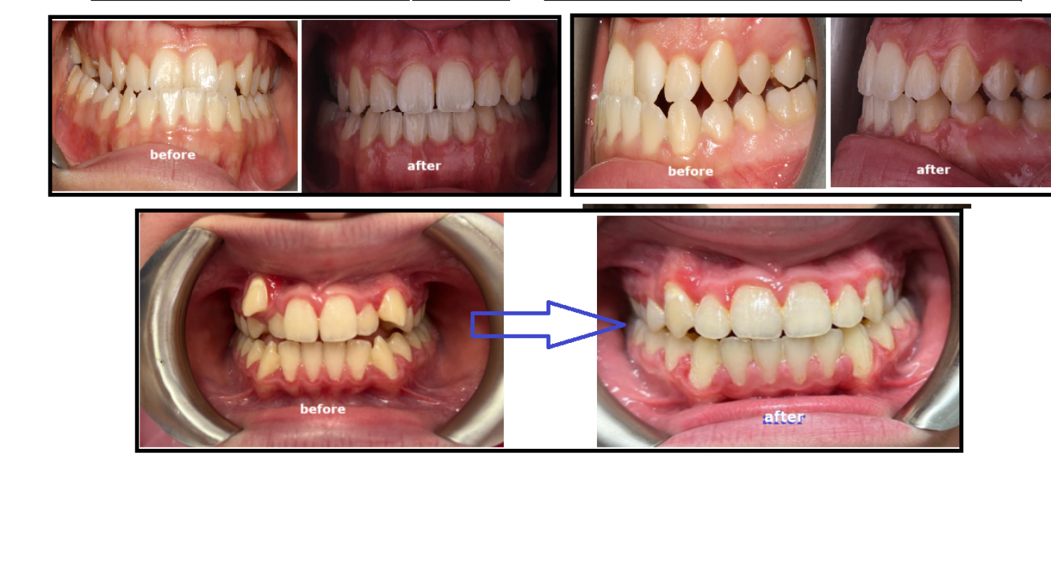 Orthodontic Before-After 