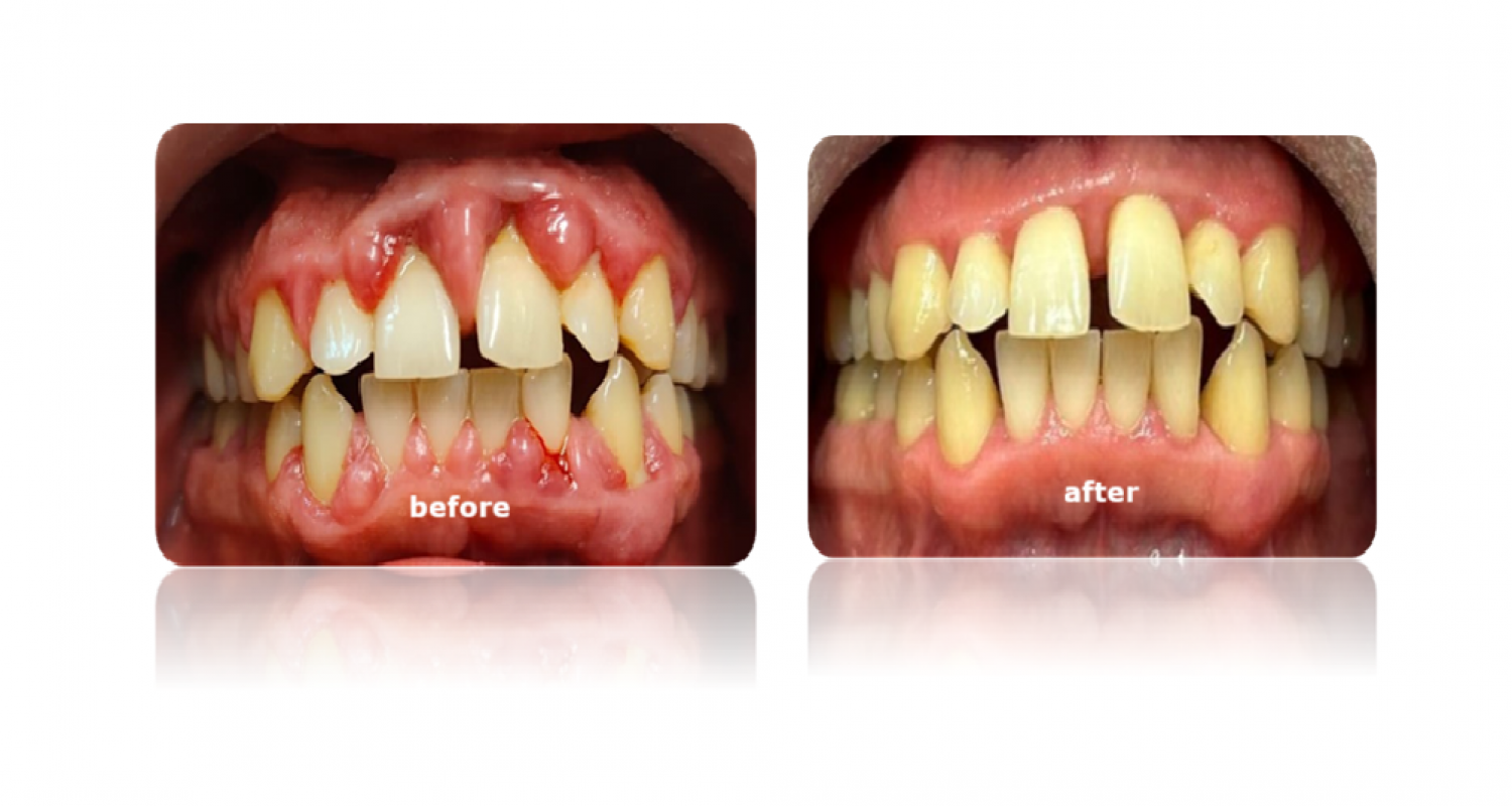 Periodontal Before-After