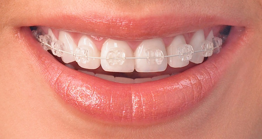 Orthodontic Braces and Treatments 